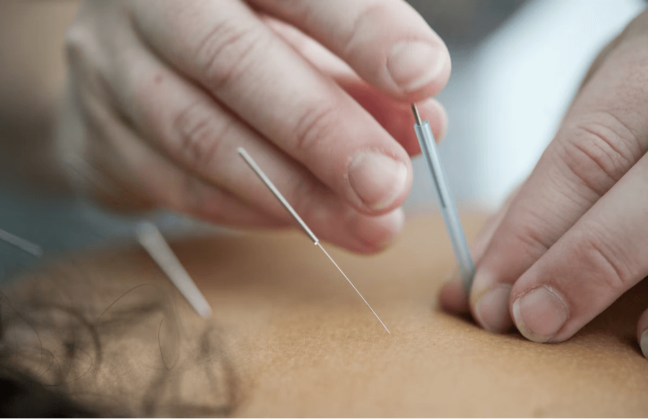 Accupunture needles